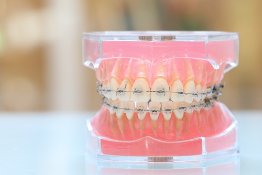 矯正歯科・矯正治療 - でい歯科医院（奈良県香芝市五位堂）