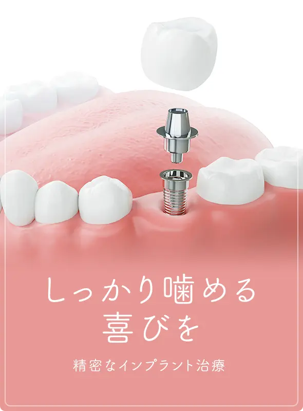 しっかり噛める喜びを 精密なインプラント治療